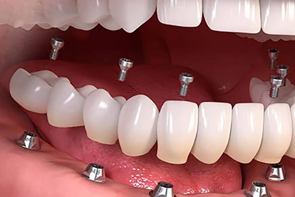 Fastsiddende tandprotese